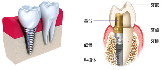 种大牙一般多少钱一颗