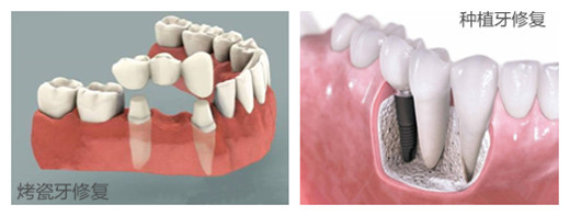 拔牙之后是镶还是种？