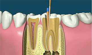 牙齿根管治疗介绍
