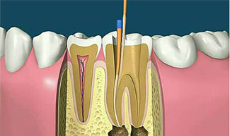 拔牙和根管治疗哪个疼