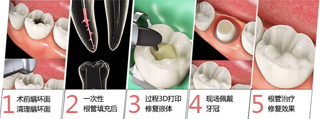 根管治疗后一定要装牙套吗