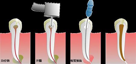 牙齿为什么要做根管治疗