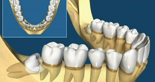 牙齿智齿要拔掉吗