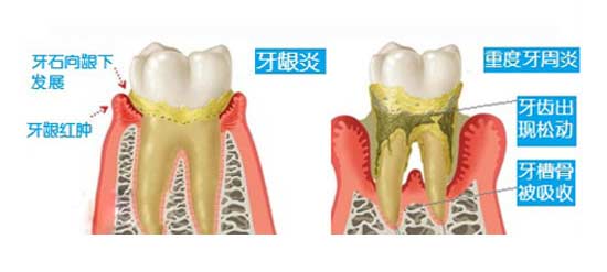 牙周炎会导致急性牙疼吗？