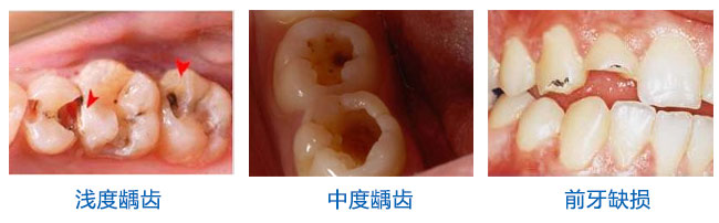 蛀牙痛到底怎么快速止痛呢