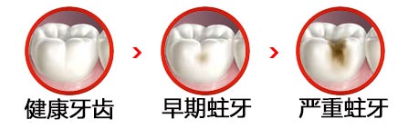 蛀牙引起的牙龈肿痛怎么办
