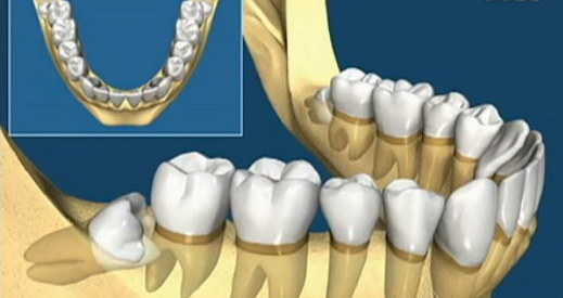 智齿牙髓炎能不能直接拔牙